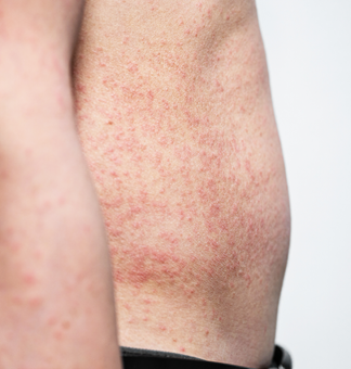 Arm with measles rash
